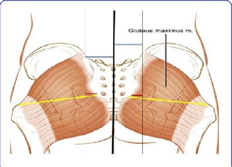 Figure 1 from The Proximal Origin of the Gluteus Maximus: A Cadaveric ...