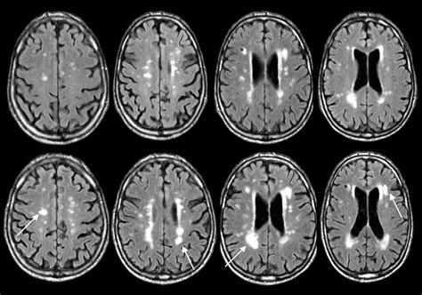 Progression of cerebral white matter lesions in Alzheimer’s disease: a new window for therapy ...