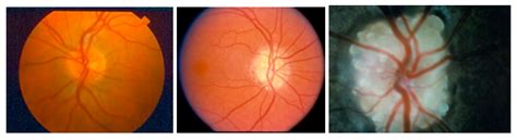 Optic Disc Drusen | North American Neuro-Ophthalmology Society