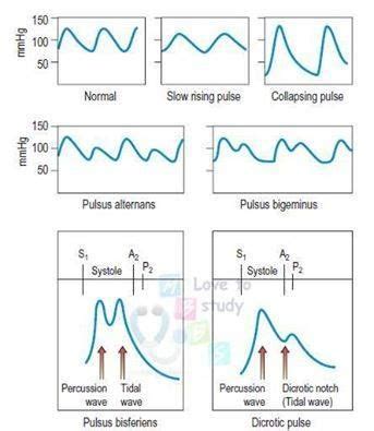 Different characters of Arterial Pulses. Collapsing pulse is apparent in conditions such as ...