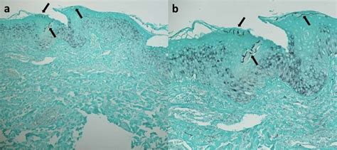 Cureus | Tinea Corporis Masquerading as a Diffuse Gyrate Erythema: Case Report and a Review of ...