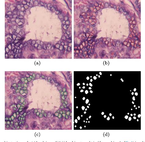 Effective segmentation of orphan annie-eye nuclei from papillary ...