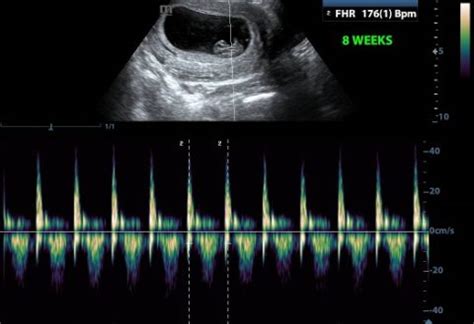 Baby’s Heart-Beat – Does it Really Tell you the Baby’s Gender ...