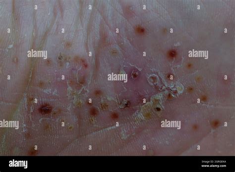 severe pustular psoriasis lesions on the sole of the foot Stock Photo ...