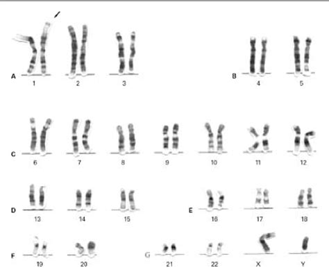 Chromosome 1, monosomy 1p | Semantic Scholar