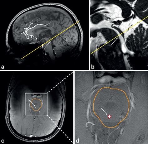 Cerebral Aqueduct Mri