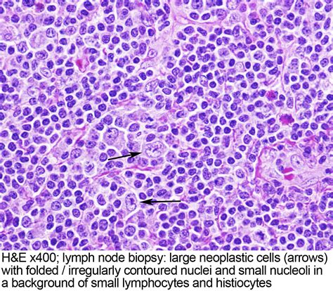 Lymph Node Histology Pathology Outlines