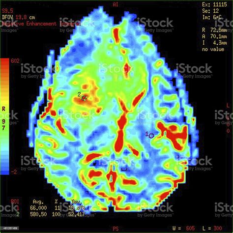 Perfusion Mri Imaging Of A Malignant Brain Tumor Stock Photo - Download ...