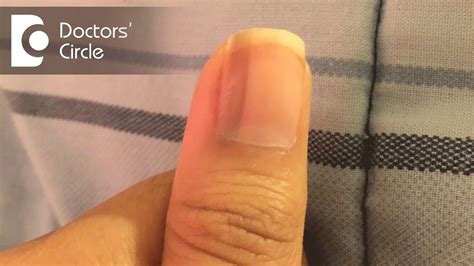 What causes vertical black lines on fingernails? - Dr. Aruna Prasad ...