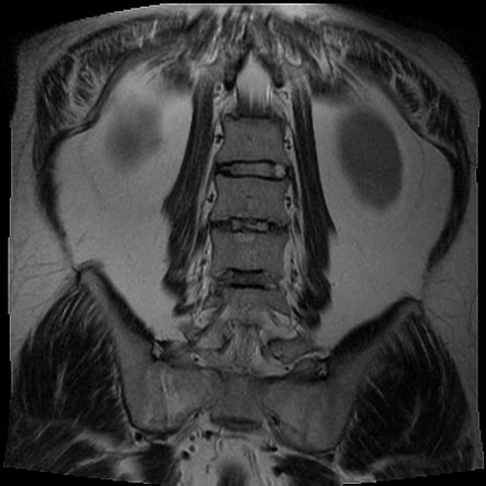 Ankylosing spondylitis - sacroiliac joints | Radiology Case ...