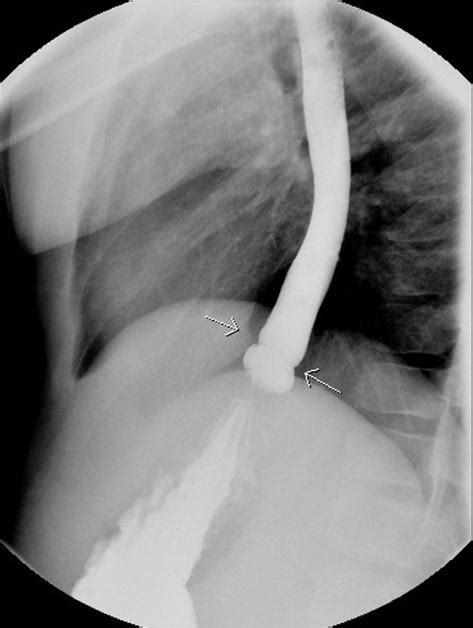 A 12-year-old boy who has dysphagia has an indentation in the distal... | Download Scientific ...