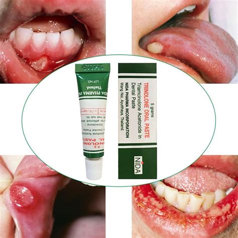 1pcs Oral Care Mouth Ulcer Relief Gel Natural Herbal Oral Antibacterial Cream Fast Relief from ...