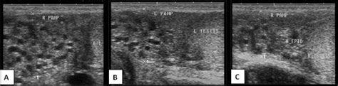 Ultrasound image of pampiniform plexus :(A) anechoic black circular... | Download Scientific Diagram