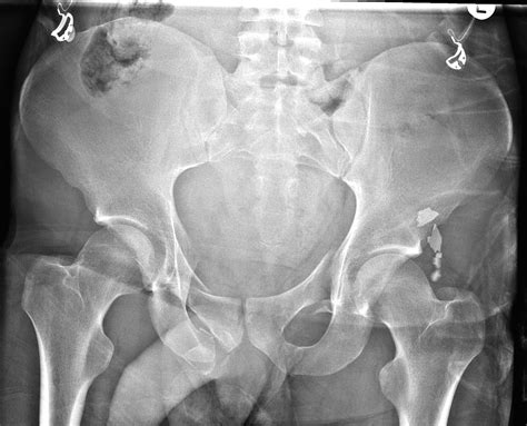 Pelvic Fractures — Kwak Talk