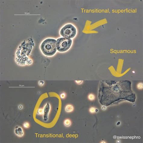 Urine Sediment of the Month: 4 Flavors of Nucleated Cells - Renal Fellow Network