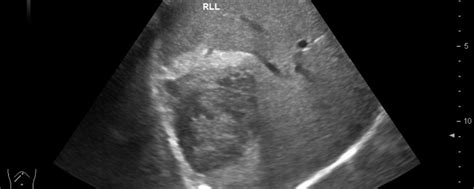 Hepatocellular carcinoma 02 [2 images] – EFSUMB