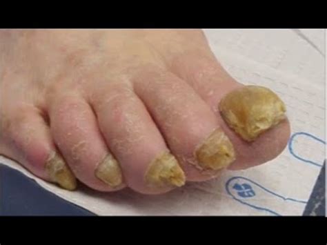 How To Get Rid Of Bad Toenail Fungus Review 2 - YouTube