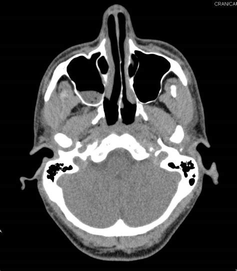 3D of Mucosal Thickening of Maxillary Sinus on Right - Neuro Case ...