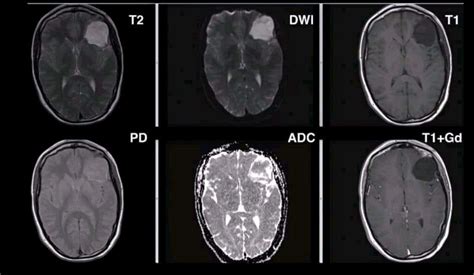 Epidermoid Cyst