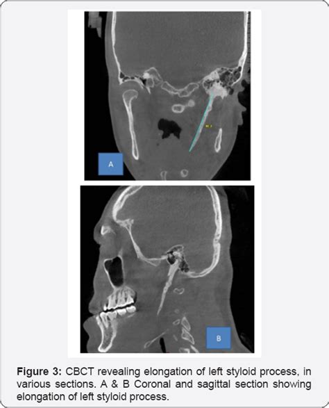 Styloid Process X Ray