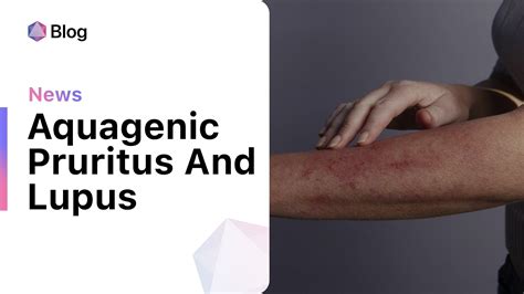 Understanding the Connection Between Pruritus and Lupus