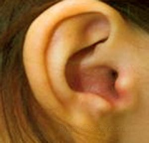 Swollen Ear Canal: Causes , Pictures, Symptoms, Infection, Treatment ...