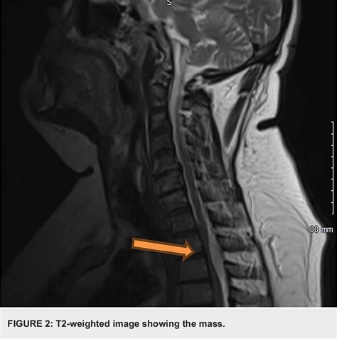 [PDF] A Case of Thoracic Epidural Angiolipoma Causing Severe Spinal ...