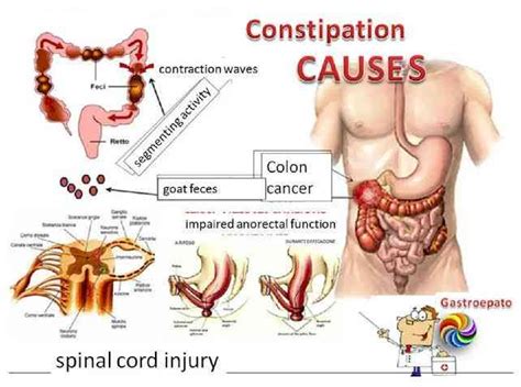 Causes of constipation