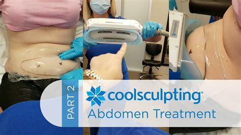 CoolSculpting Treatment: Lower Abdomen (Part 2) - YouTube