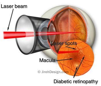 Laser retinal photocoagulation