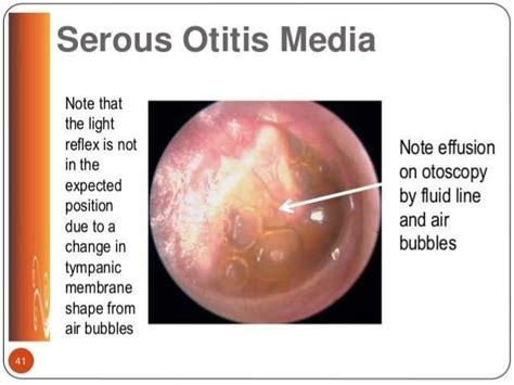 Otitis Media with Effusion / Secretory Otitis Media