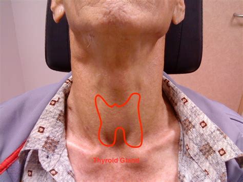 Thyroid cancer | ENT Clinic