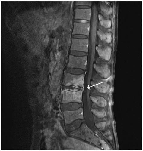 Abnormal Mri Lumbar Spine Disc