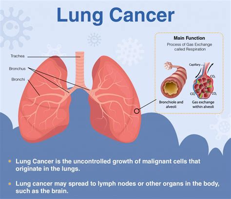 Lung Cancer: Signs, Symptoms, Diagnosis & Treatment - Dr Lal PathLabs Blog