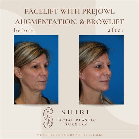 Facelift Chattanooga | Facelift Surgery | Facelifts near Me