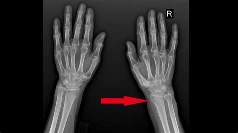 Distal Radius Fracture