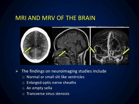 Idiopathic intracranial hypertension