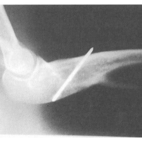 -a) Congenital proximal radioulnar synostosis. Preoperative x-ray, b ...