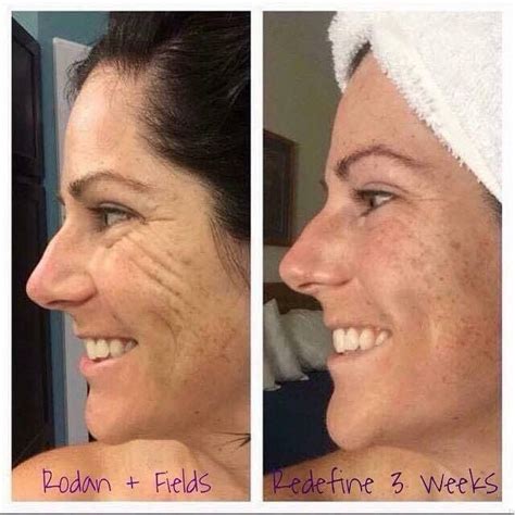 Rodan And Fields Before And After Redefine - All You Need Infos