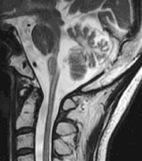 Primary lateral sclerosis: diagnosis and management | Practical Neurology