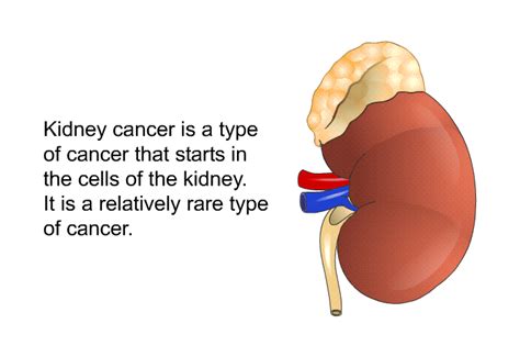 PatEdu.com : Kidney Cancer