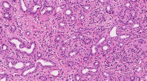 Bile duct adenoma | MyPathologyReport.ca