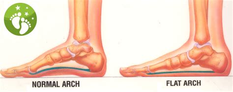 Normal and Flat Arch - Dr. Stephanie Carollo Foot and Ankle Care