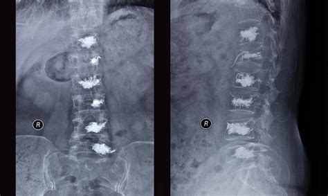 Vertebroplasty is not a do-not-do treatment | The Medical Journal of Australia