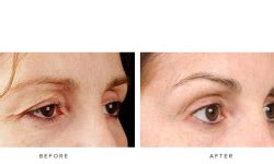 Thermage Eye Before and After Images | Infinity Skin Clinic