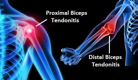 Distal Biceps Tendonitis Brace