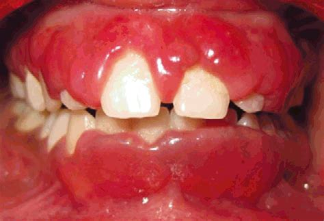 Plasma Cell Gingivitis – Exodontia