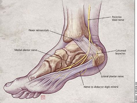 Tarsal Tunnel Syndrome