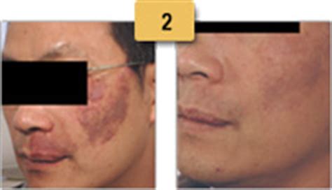 See Before and After Pictures of Vascular Birthmark Laser Removal