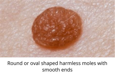 Skin Moles to Worry About – A Complete Guide With Skin Moles Pictures